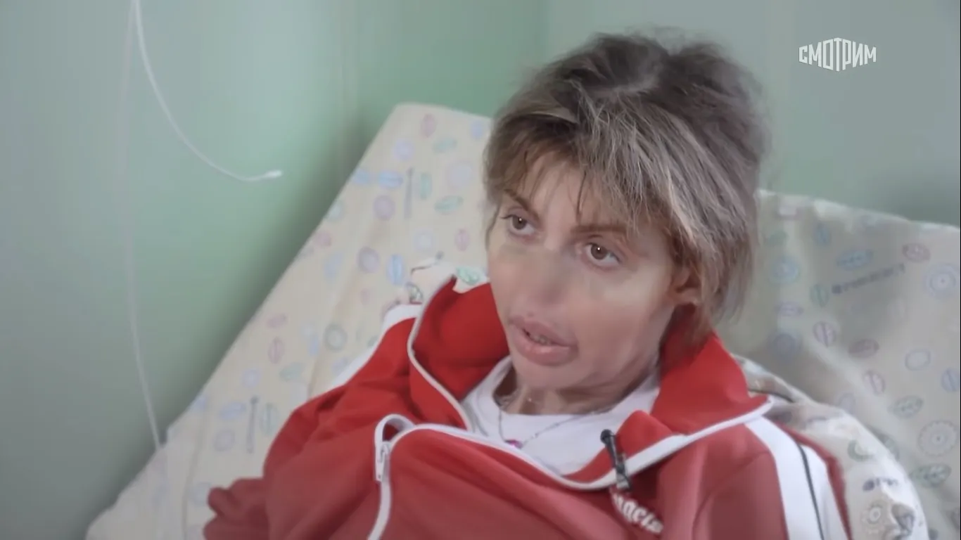 У бывшей жены Андрея Аршавина нет кончика носа. Малахов из-за развода назвал экс-футболиста «Зенита» ублюдком