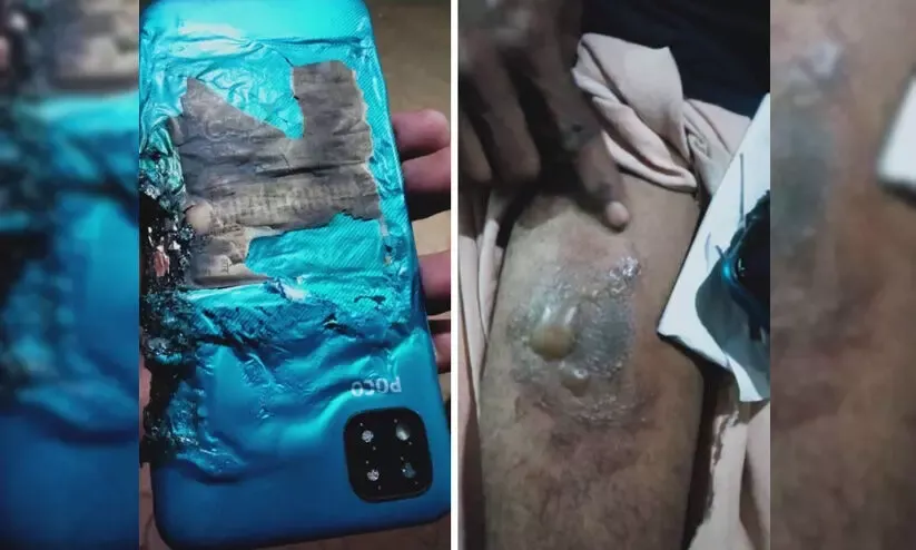 Xiaomi Poco C3 взорвался в кармане владельца и оставил метку на всю жизнь. Это новый Galaxy Note 7?